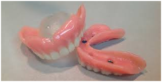 Appareil Dentaire Amovible Superieur  : La Prothèse Correspond Exactement À La Couleur Des Dents Voisines Et À La Forme De La Ou Des Dents Manquantes.